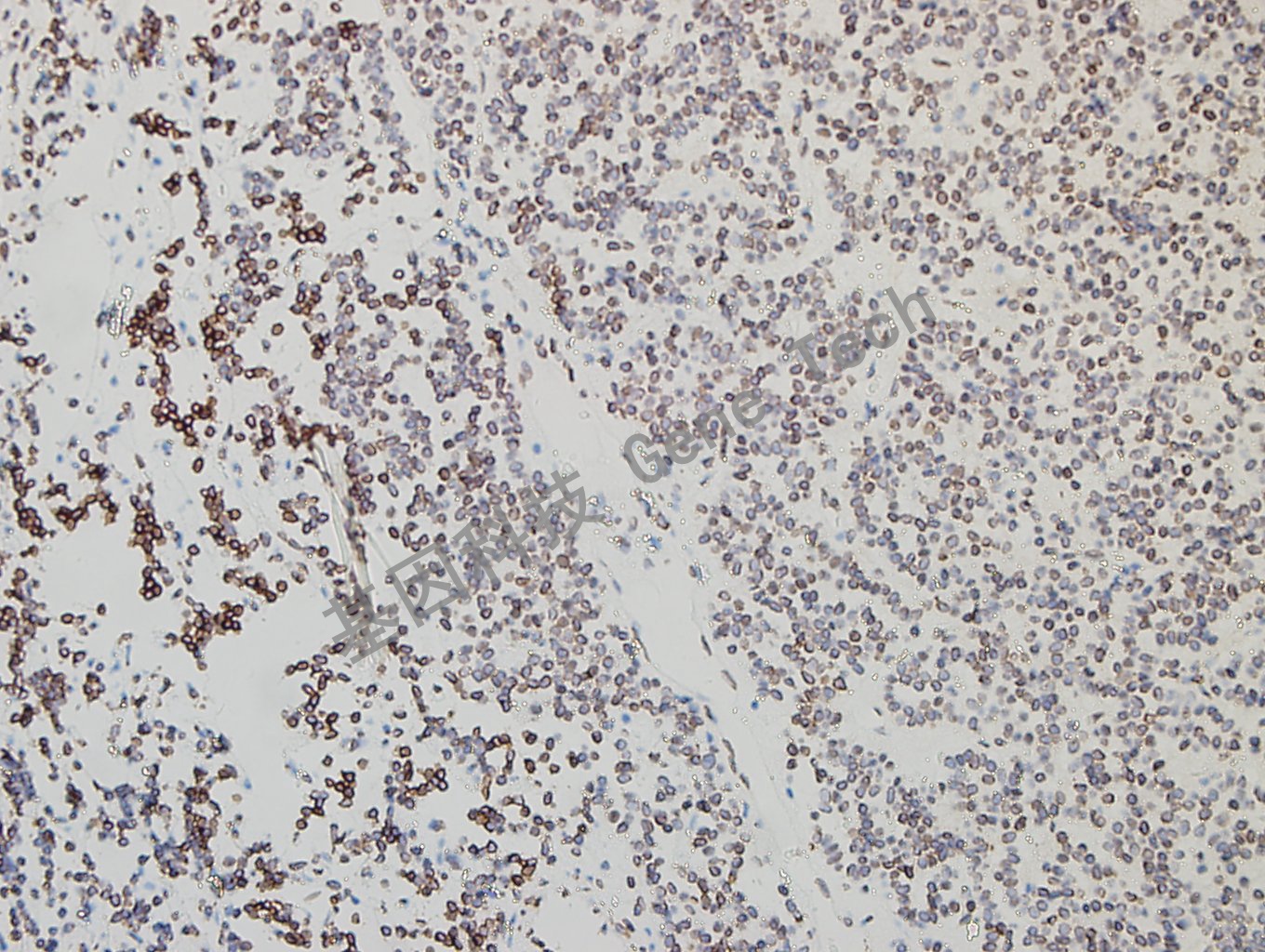 GATA2 垂体腺瘤-6_副本.jpg