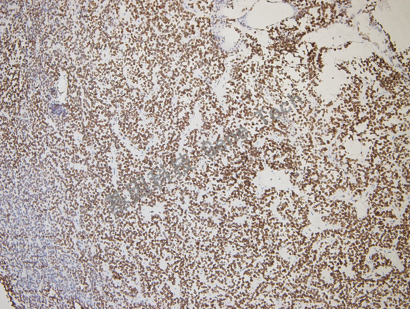 GATA2 垂体腺瘤-7_副本.jpg