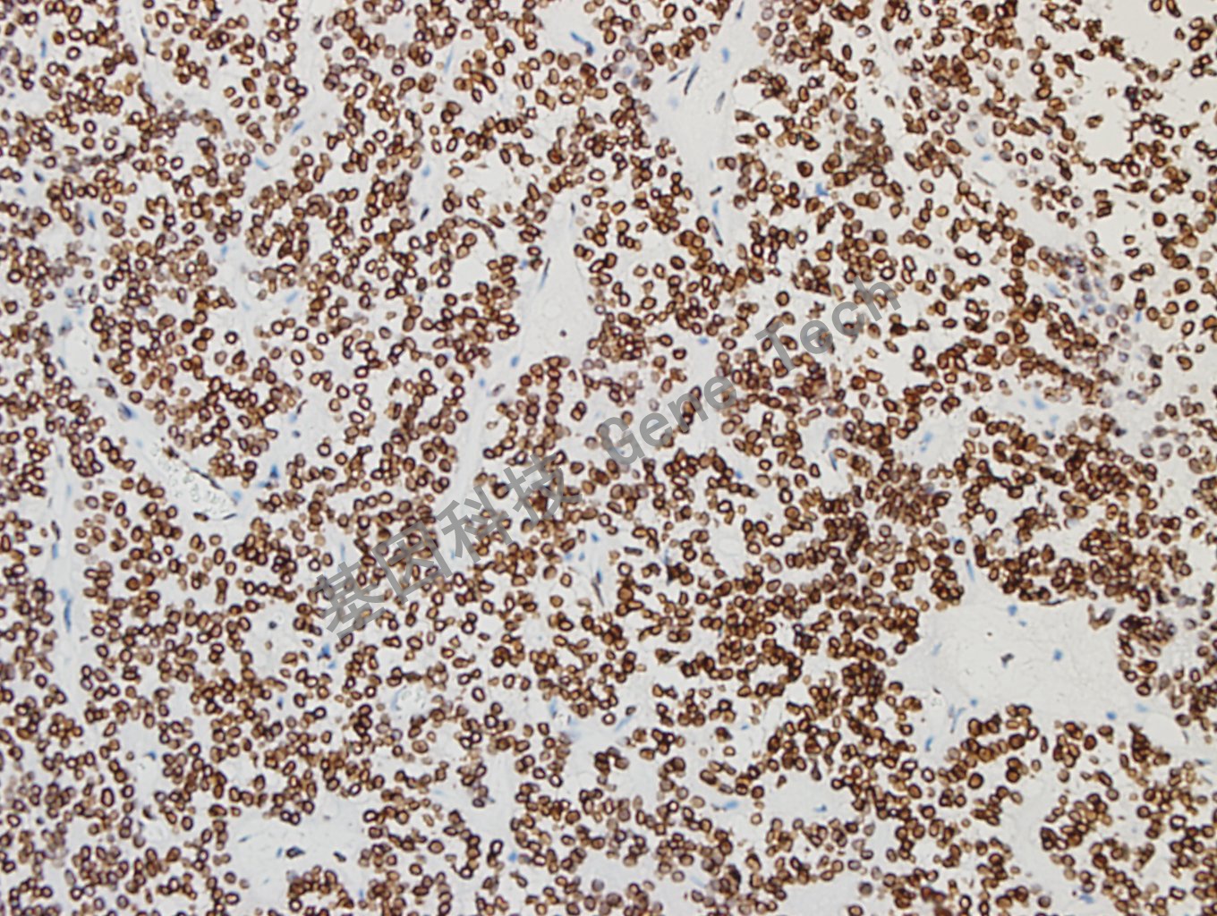 GATA2 垂体腺瘤-8_副本.jpg