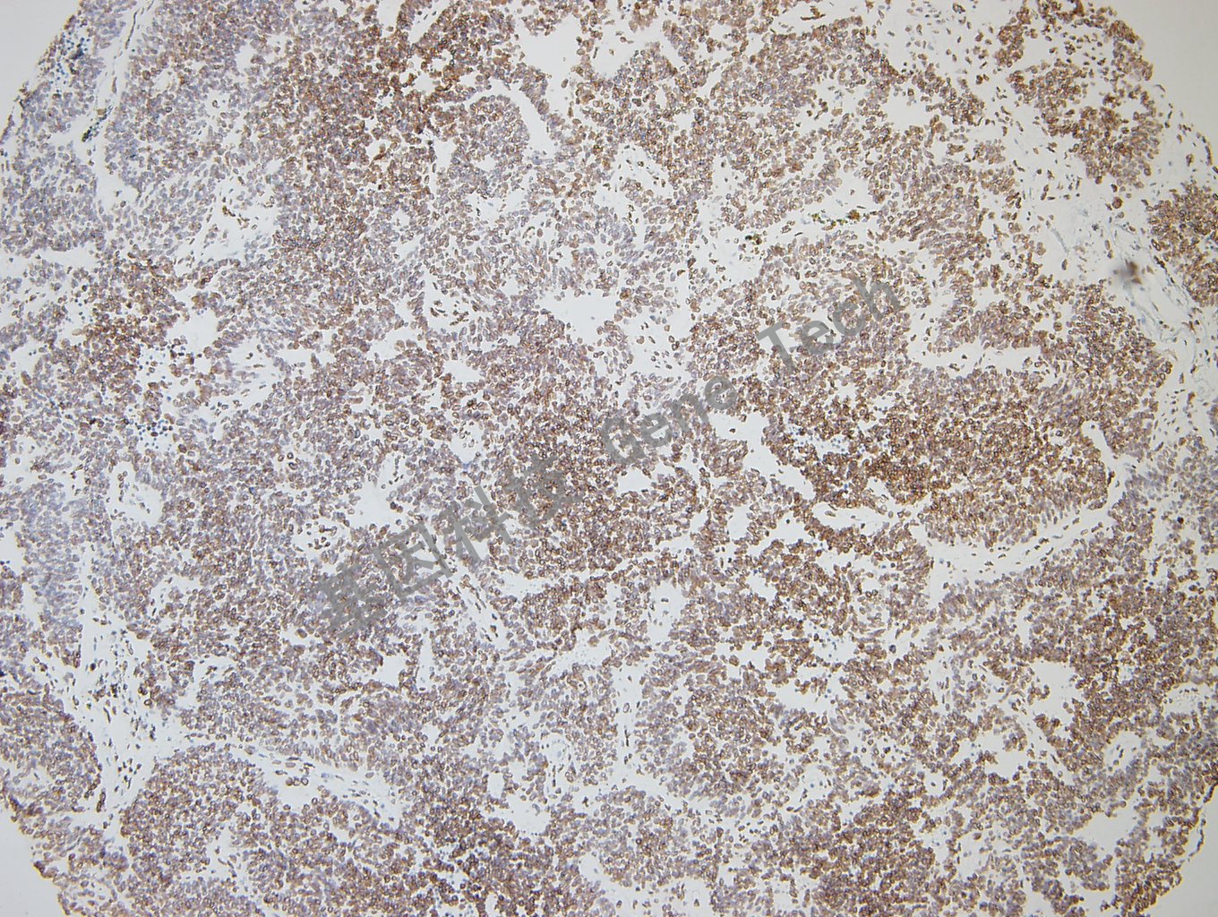 GATA2 肺癌-1_副本.jpg