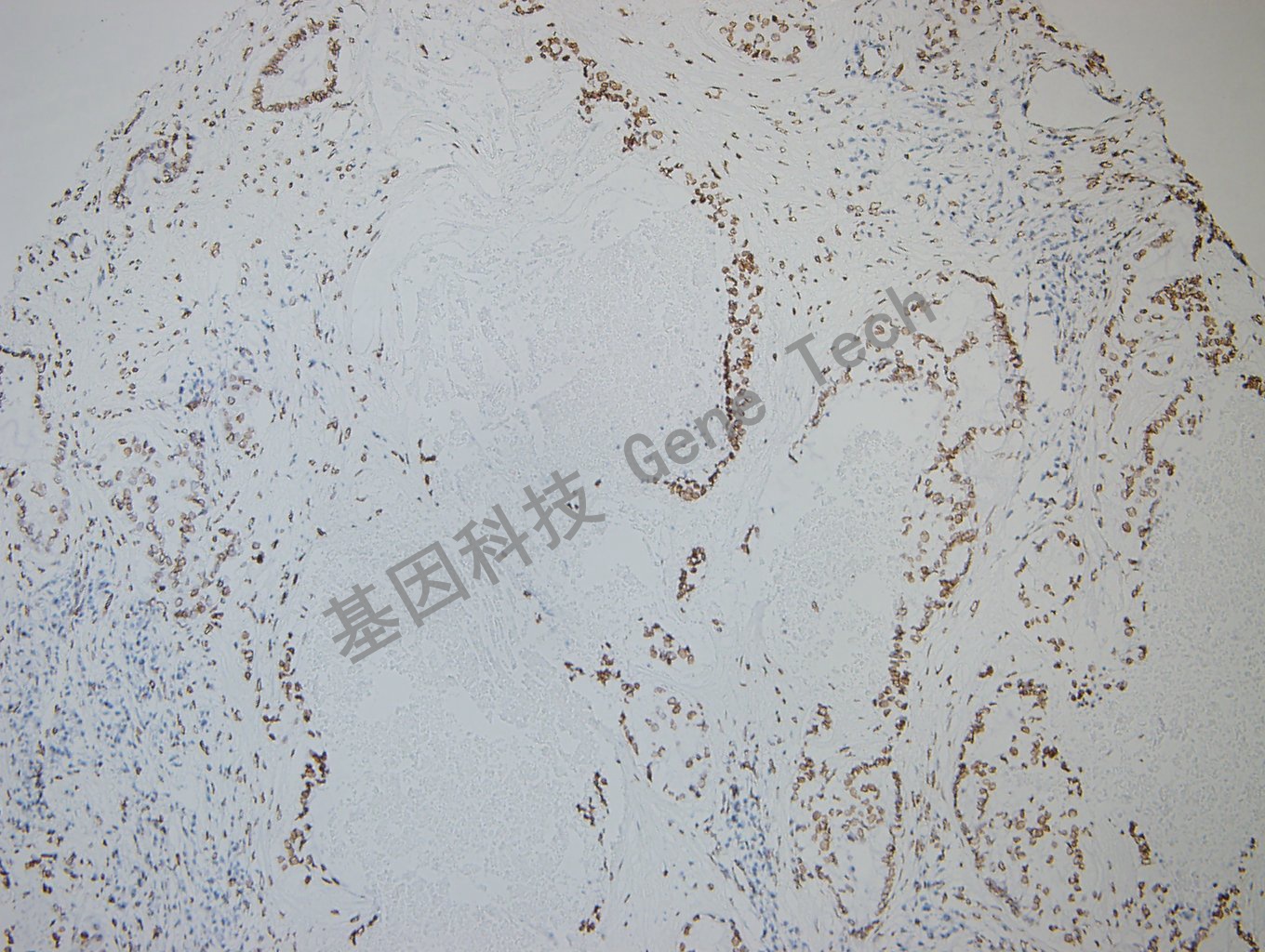 GATA2 肺癌-2_副本.jpg