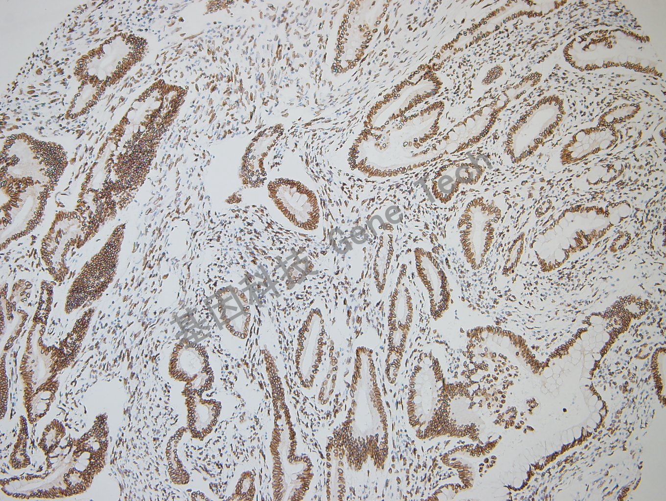 GATA2 结直肠癌-1_副本.jpg