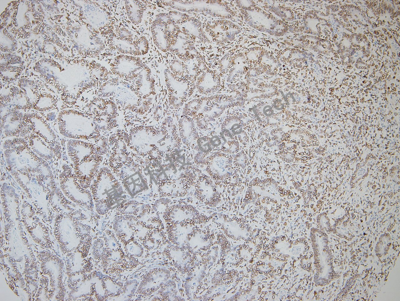 GATA2 结直肠癌-2_副本.jpg