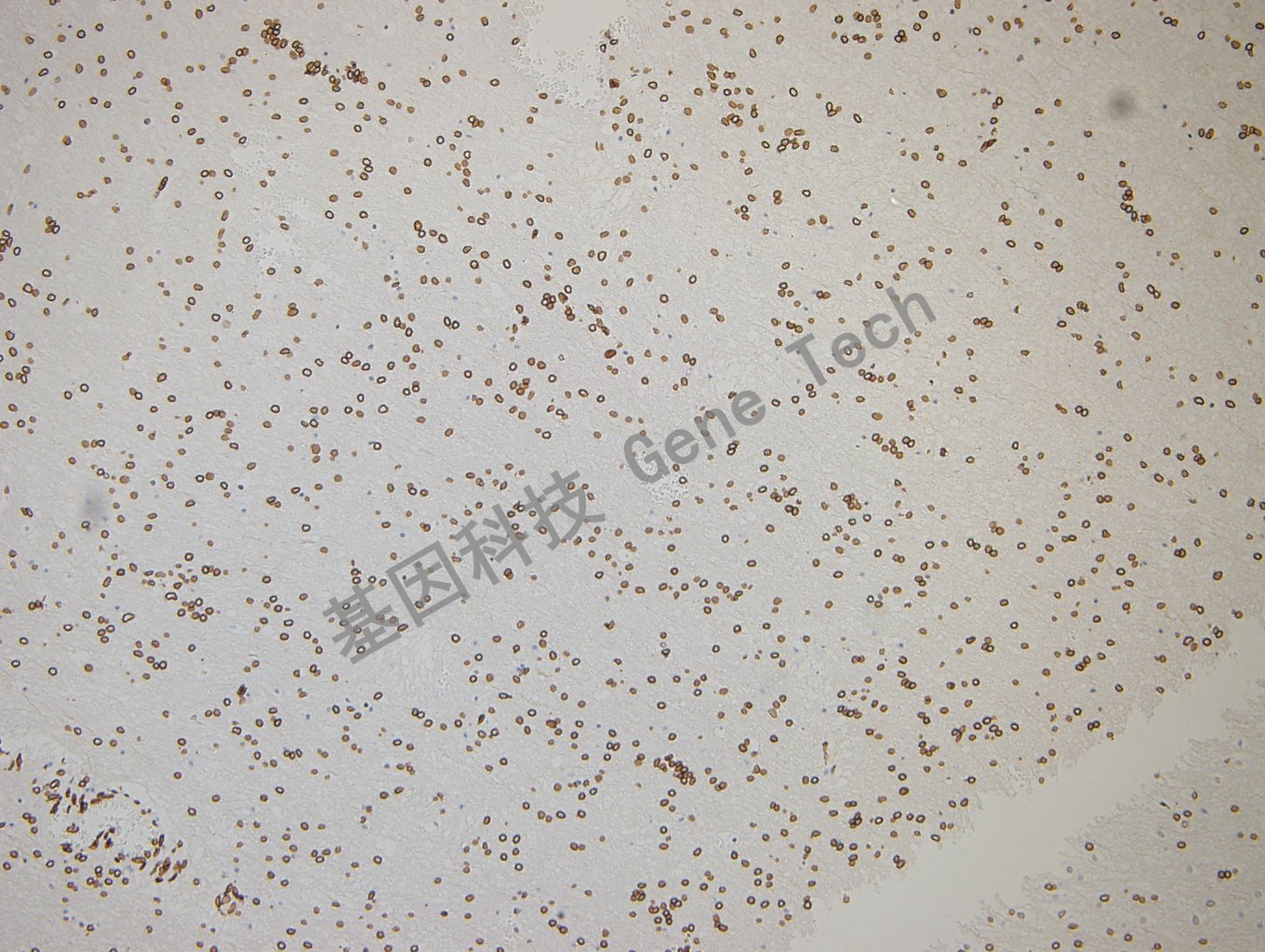 GATA2 脑胶质瘤-1_副本.jpg