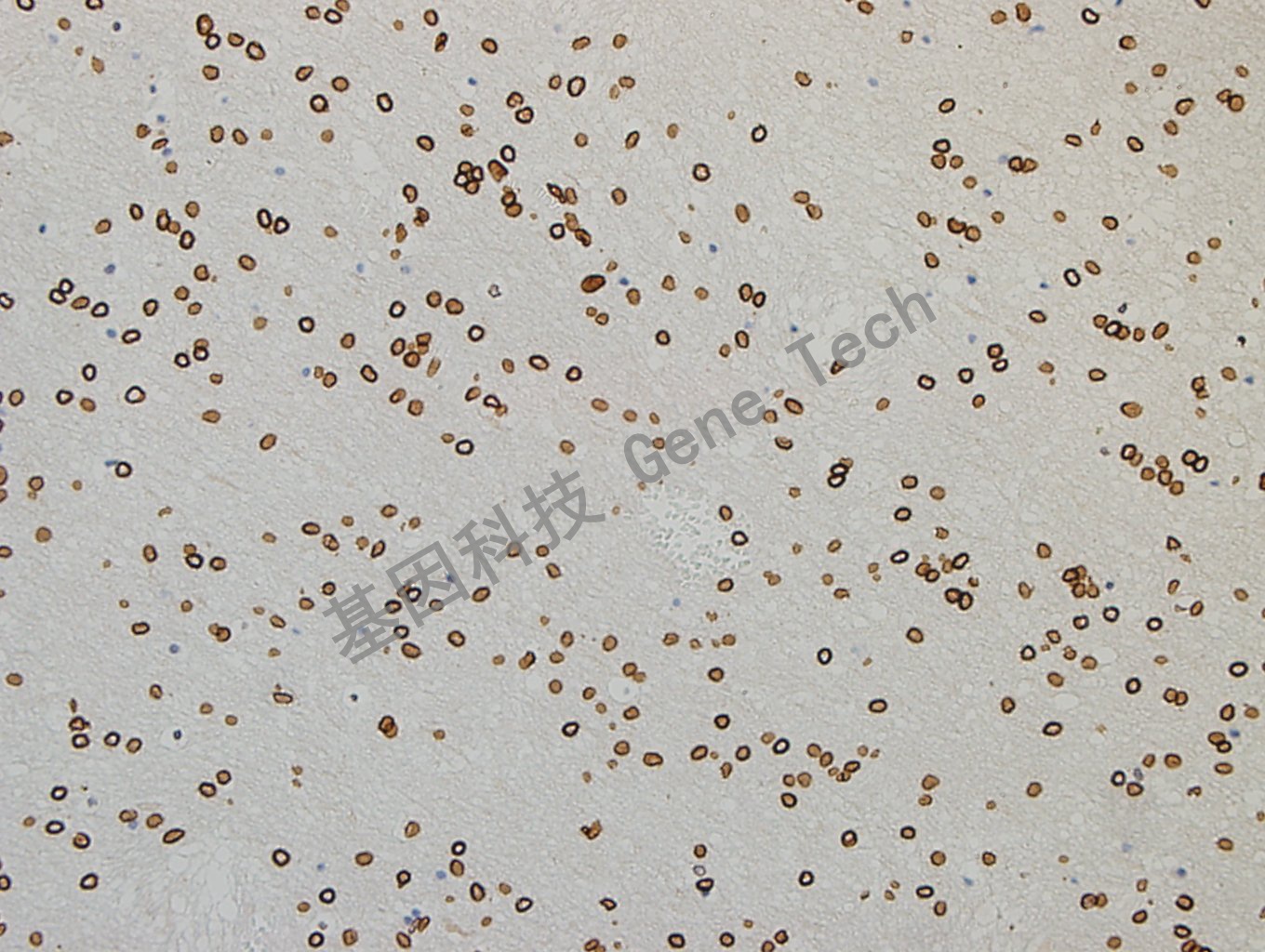 GATA2 脑胶质瘤-2_副本.jpg