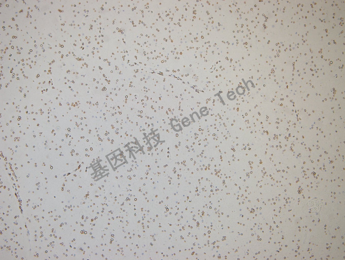 GATA2 脑胶质瘤-3_副本.jpg