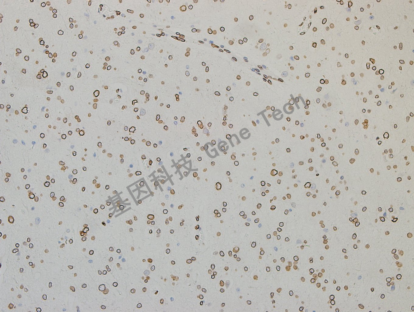 GATA2 脑胶质瘤-4_副本.jpg