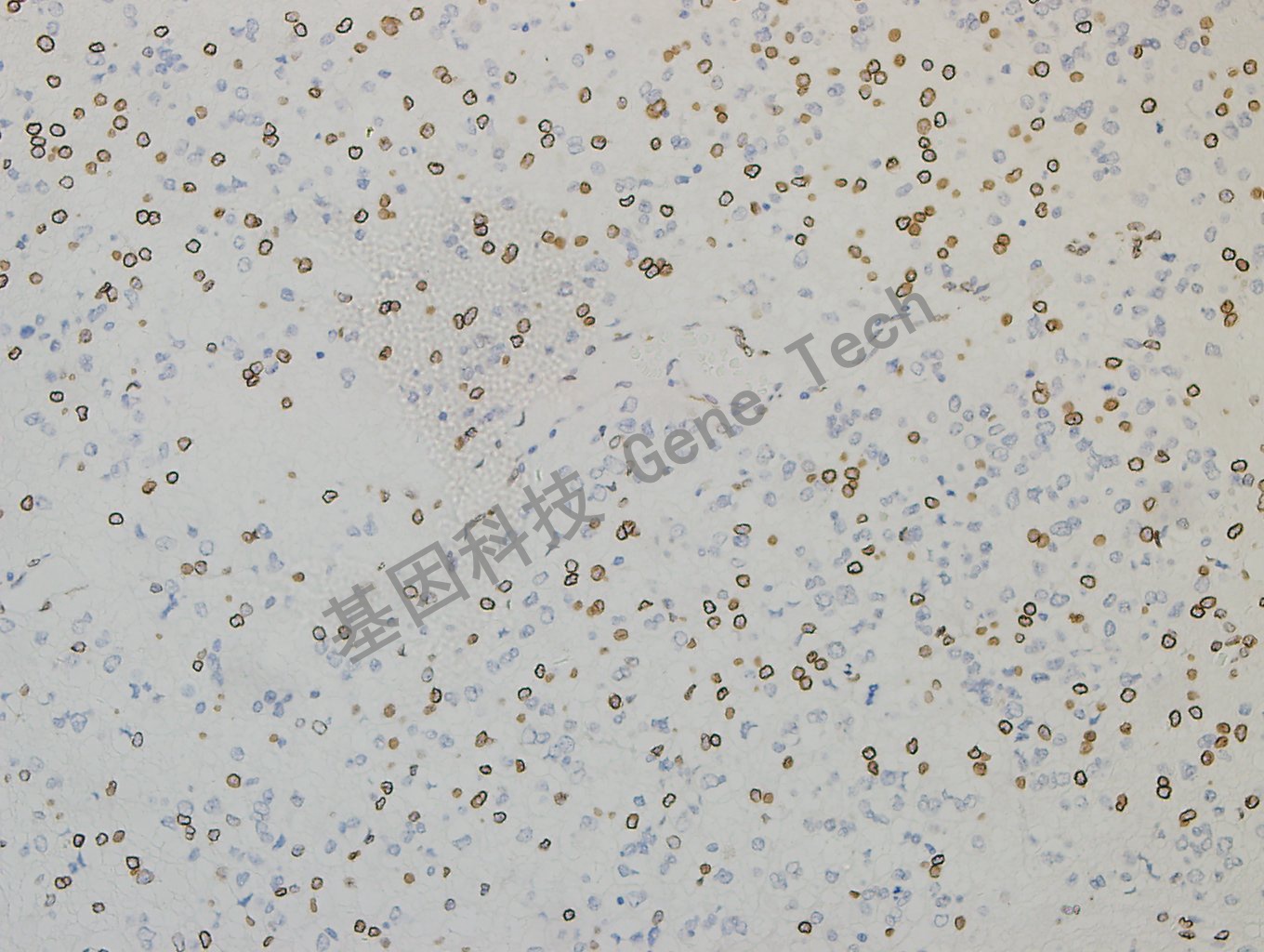 GATA2 脑胶质瘤-5_副本.jpg