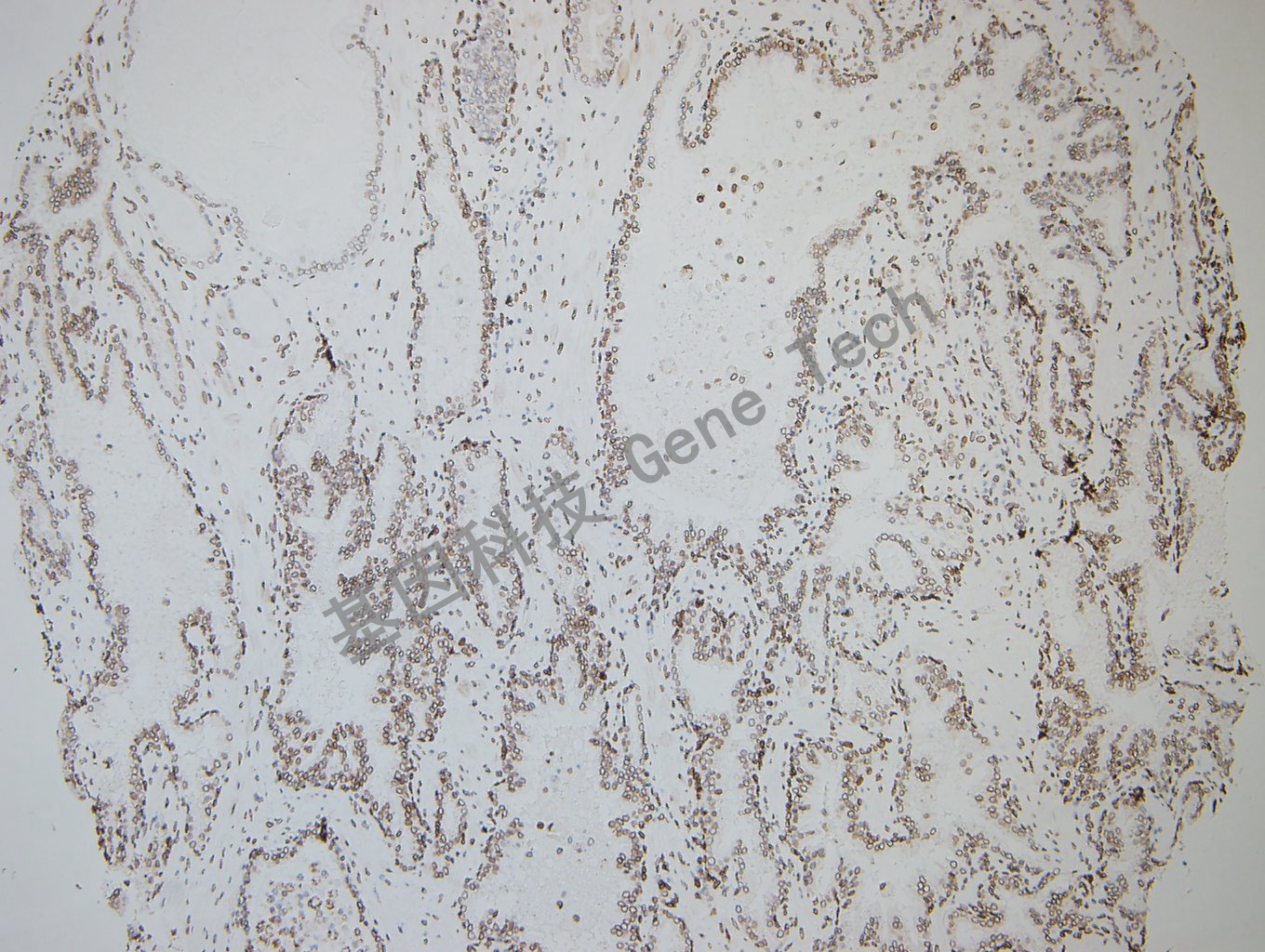 GATA2 前列腺癌_副本.jpg