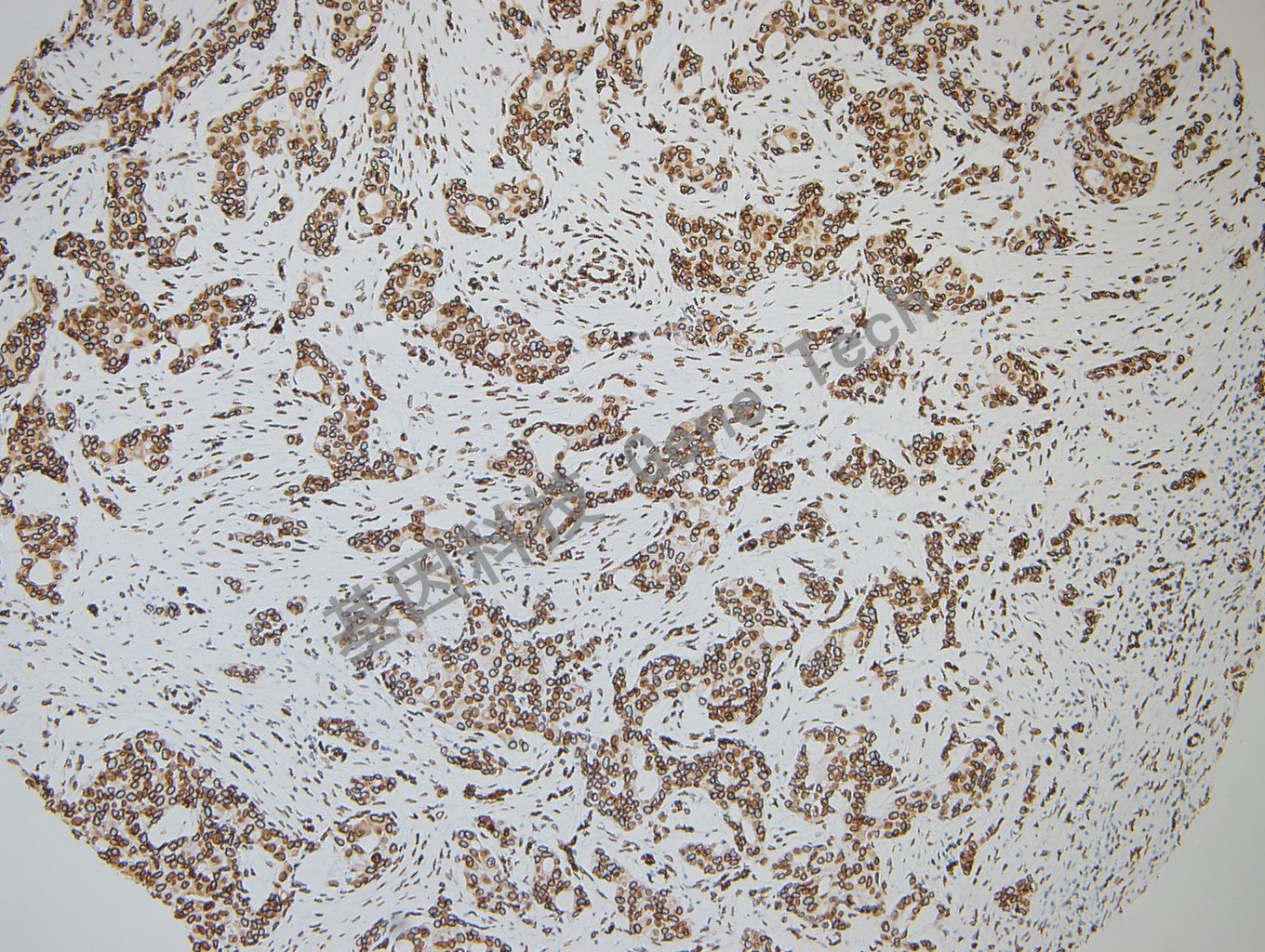 GATA2 乳腺癌-2_副本.jpg