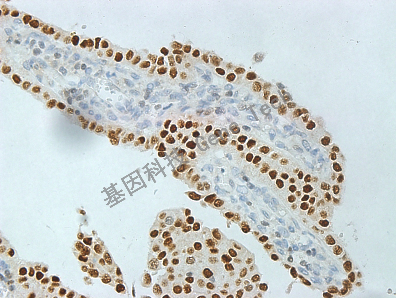 GATA3 GT2187 膀胱浸润性尿路上皮癌 10X_副本.jpg