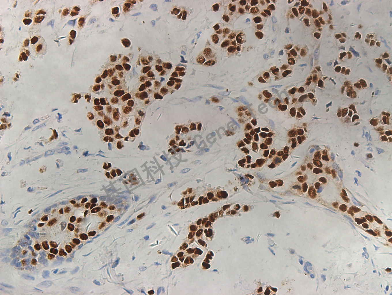 GATA3 GT2187 乳腺癌  20x   20150402-7_副本.jpg