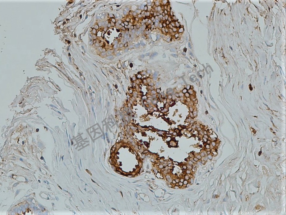 GCDFP-15 乳腺癌_副本.jpg