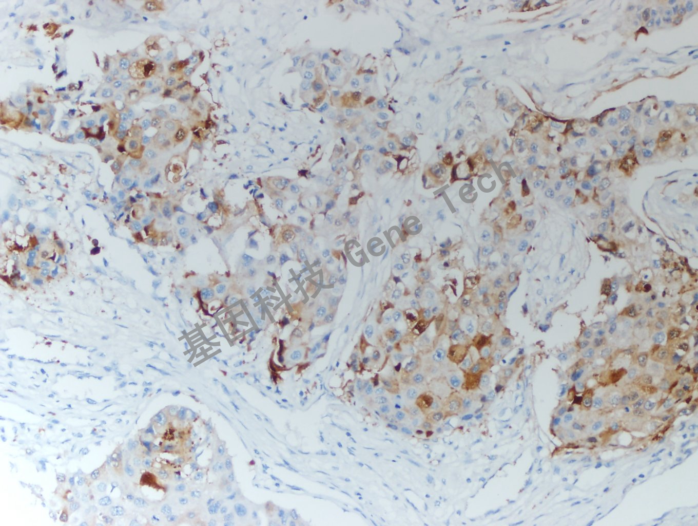 HIF-1α 乳腺癌-2_副本.jpg