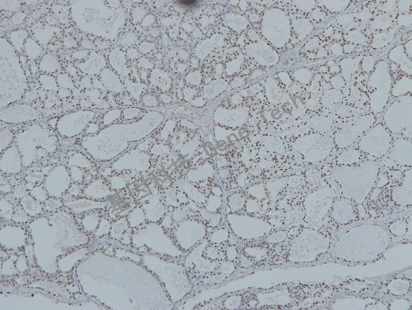 20190507-8 HNF1B L19-7 卵巢透明细胞癌-2_副本.jpg