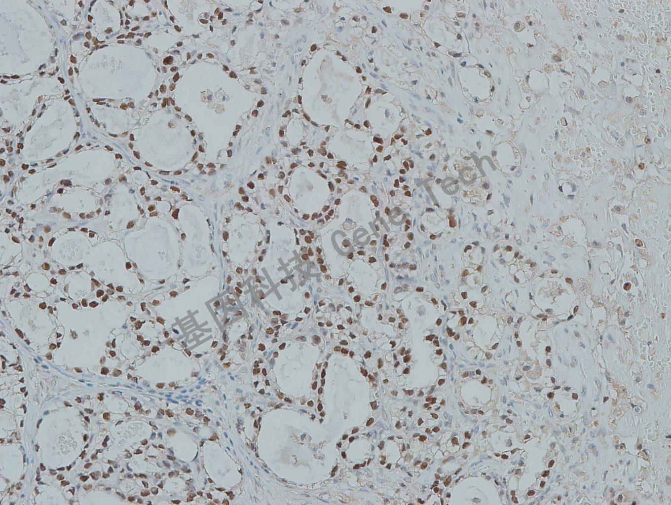 20190507-8 HNF1B L19-7 卵巢透明细胞癌-3_副本.jpg