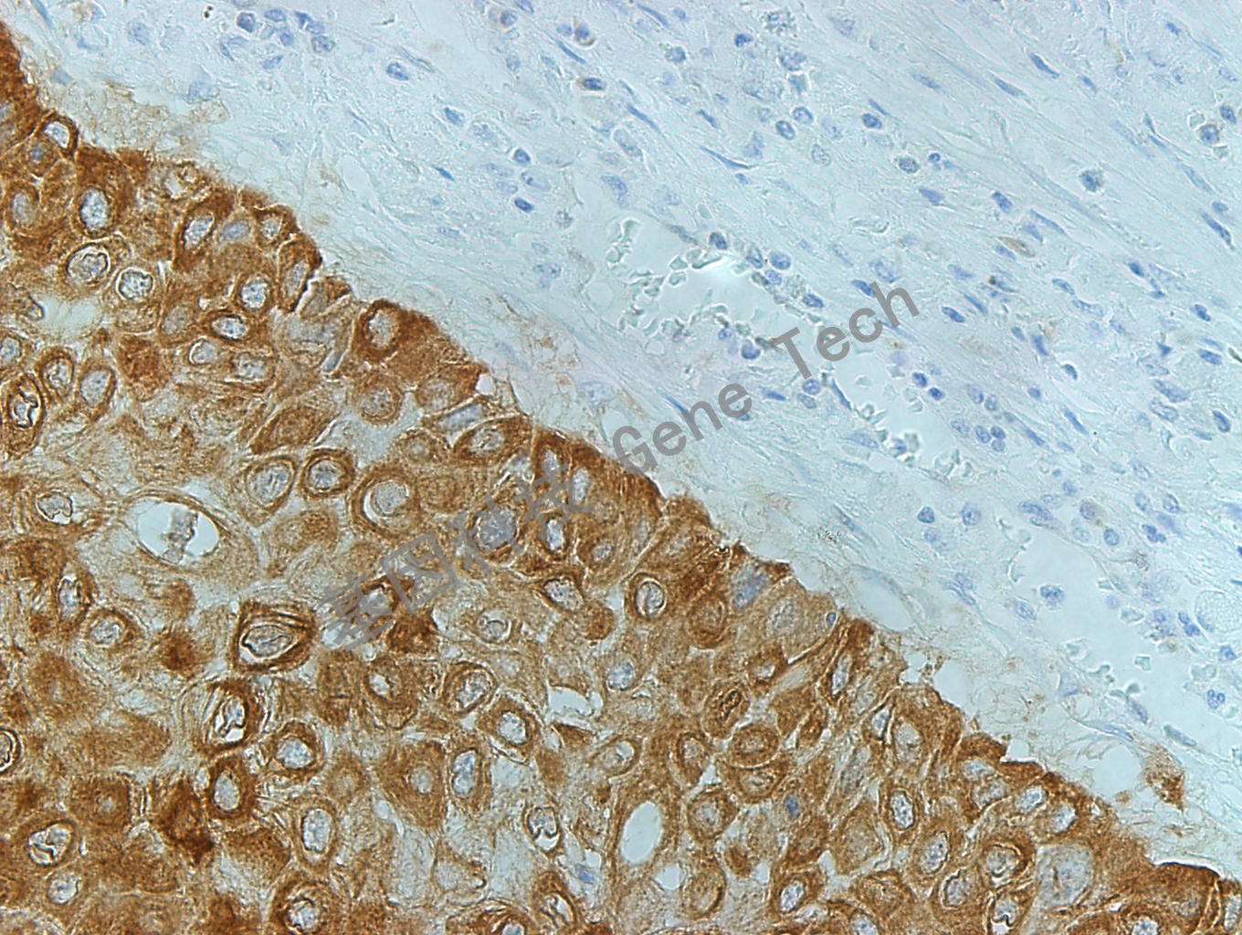 IMP3 GT2261 食管癌 40X_副本.jpg