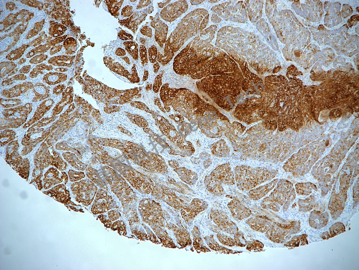 IMP3 GT2261 胃癌 10X_副本.jpg