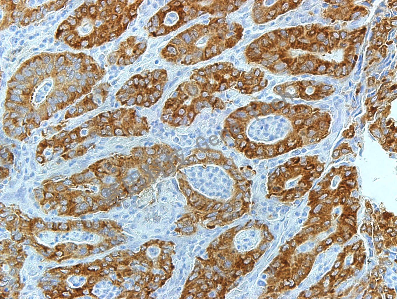 IMP3 GT2261 胃癌 40X_副本.jpg