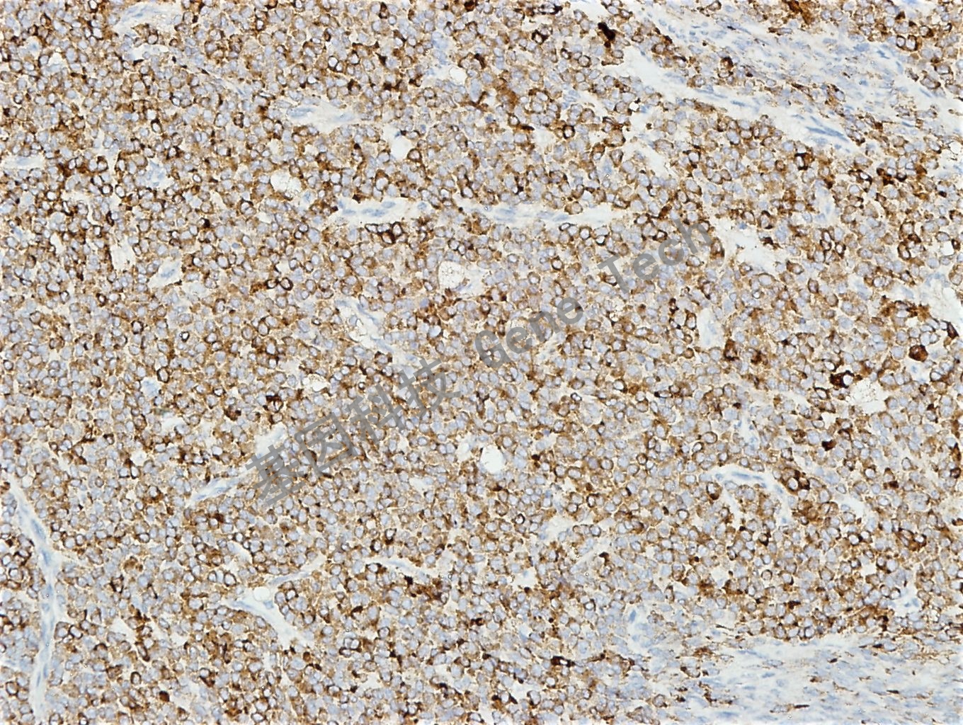 inhibin α-卵巢癌_副本.jpg