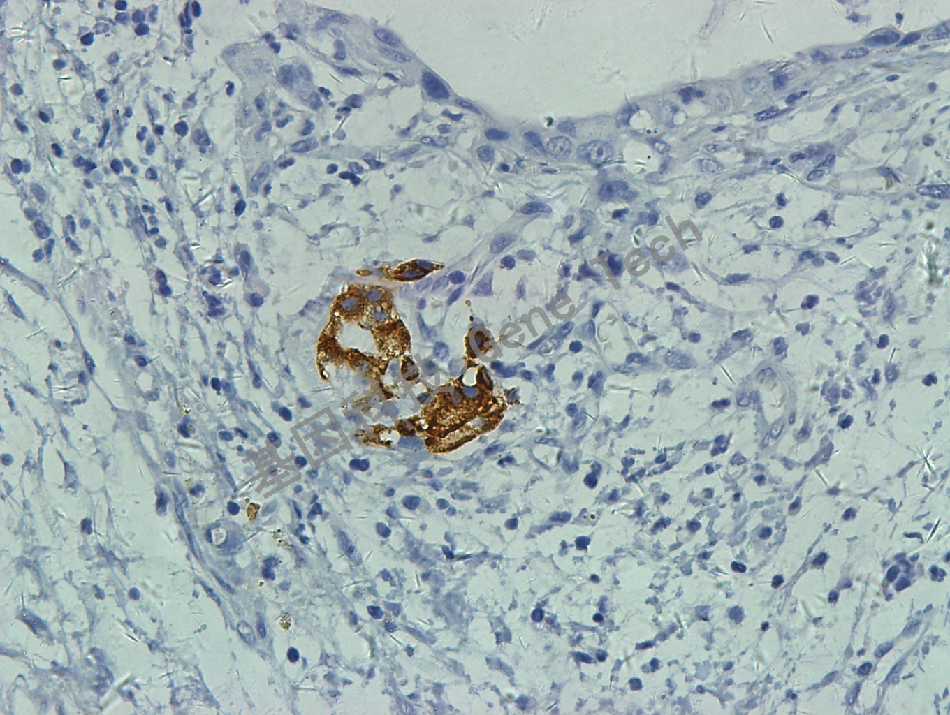 insulin GT2131 胰腺癌1 40X_副本.jpg