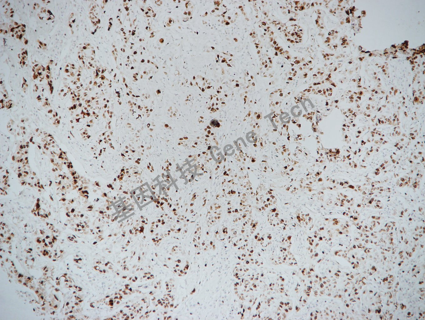 20170522-16-3 乳腺癌_副本.jpg