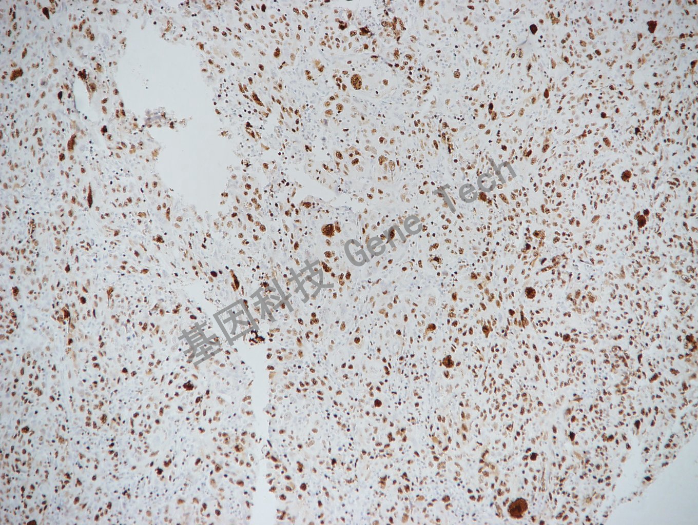 20170522-16-4 乳腺癌_副本.jpg