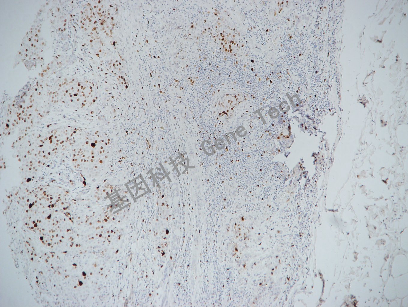 20170522-16-5 乳腺癌_副本.jpg