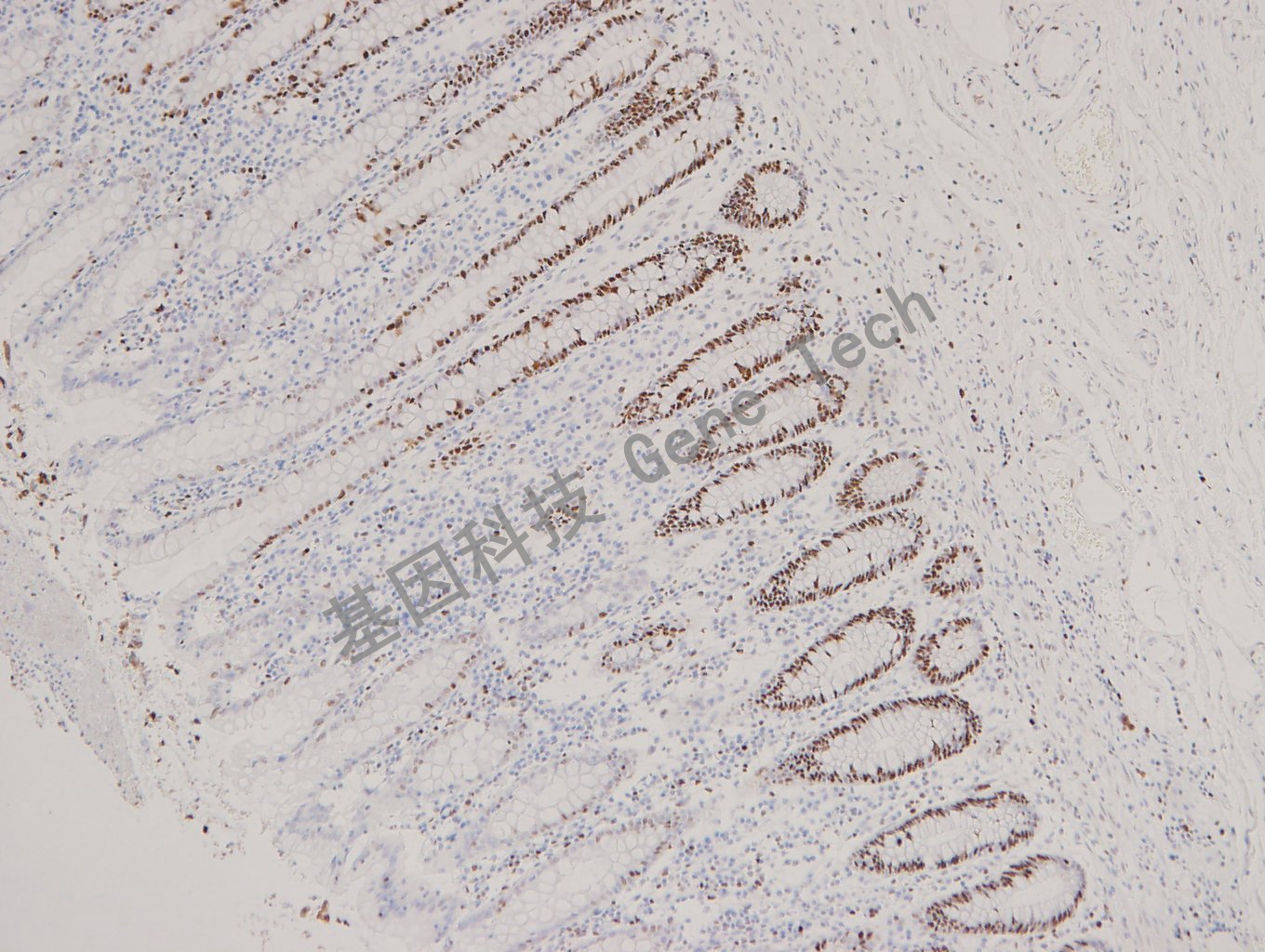 MCM2 结肠癌_副本.jpg