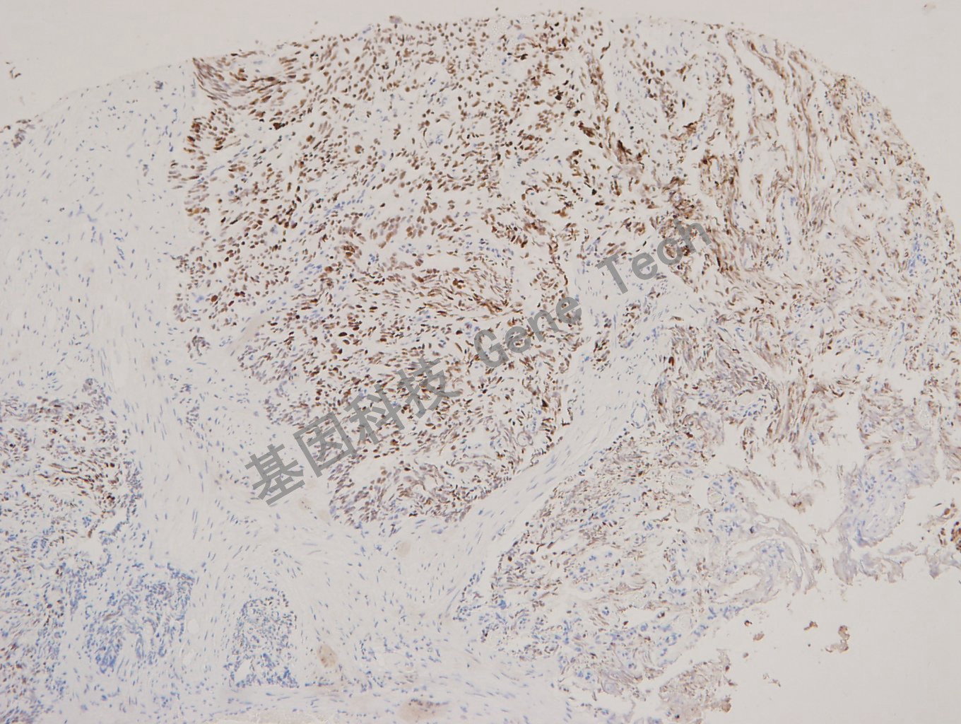 MCM2 前列腺癌_副本.jpg