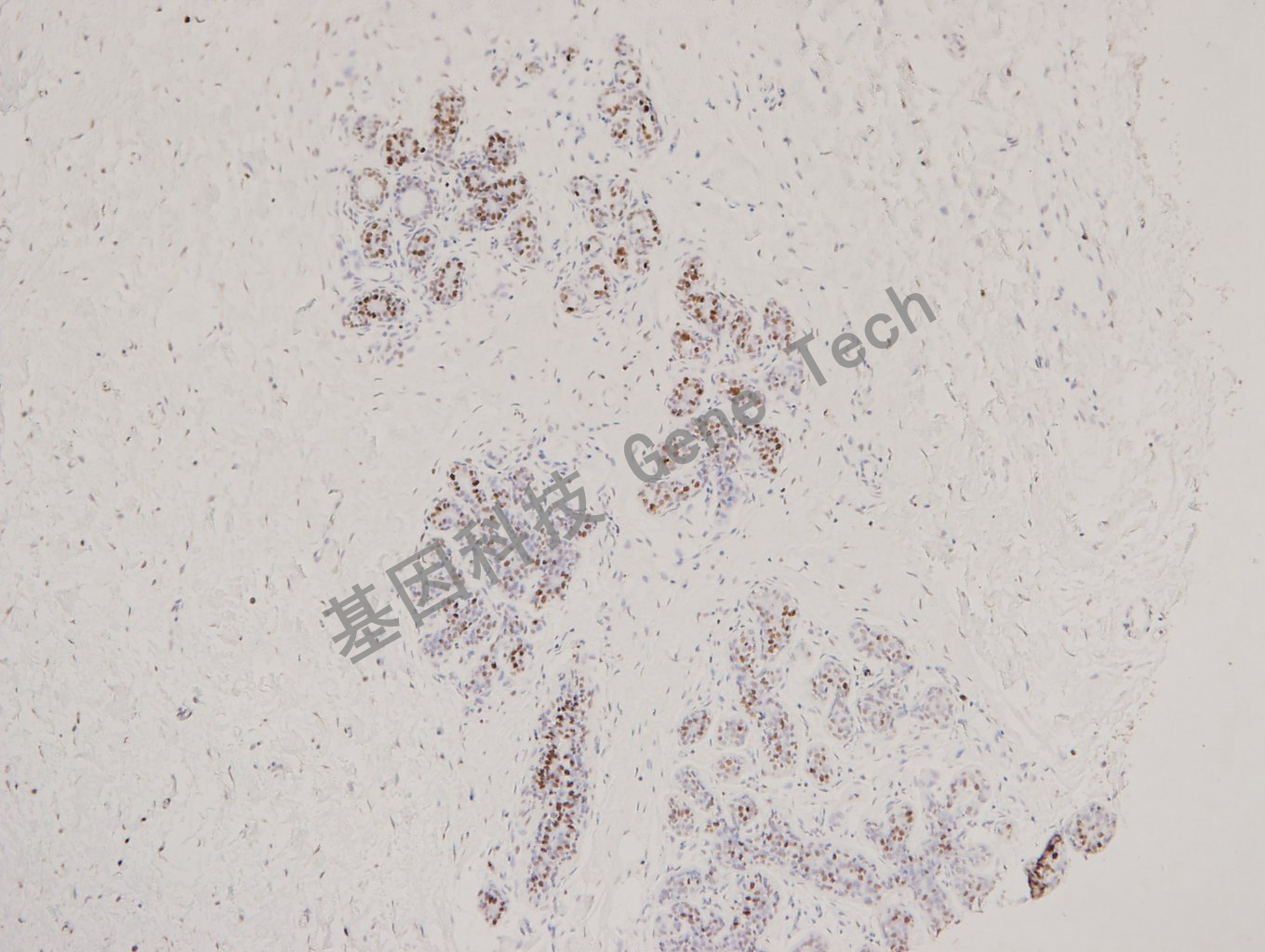 MCM2 乳腺癌_副本.jpg