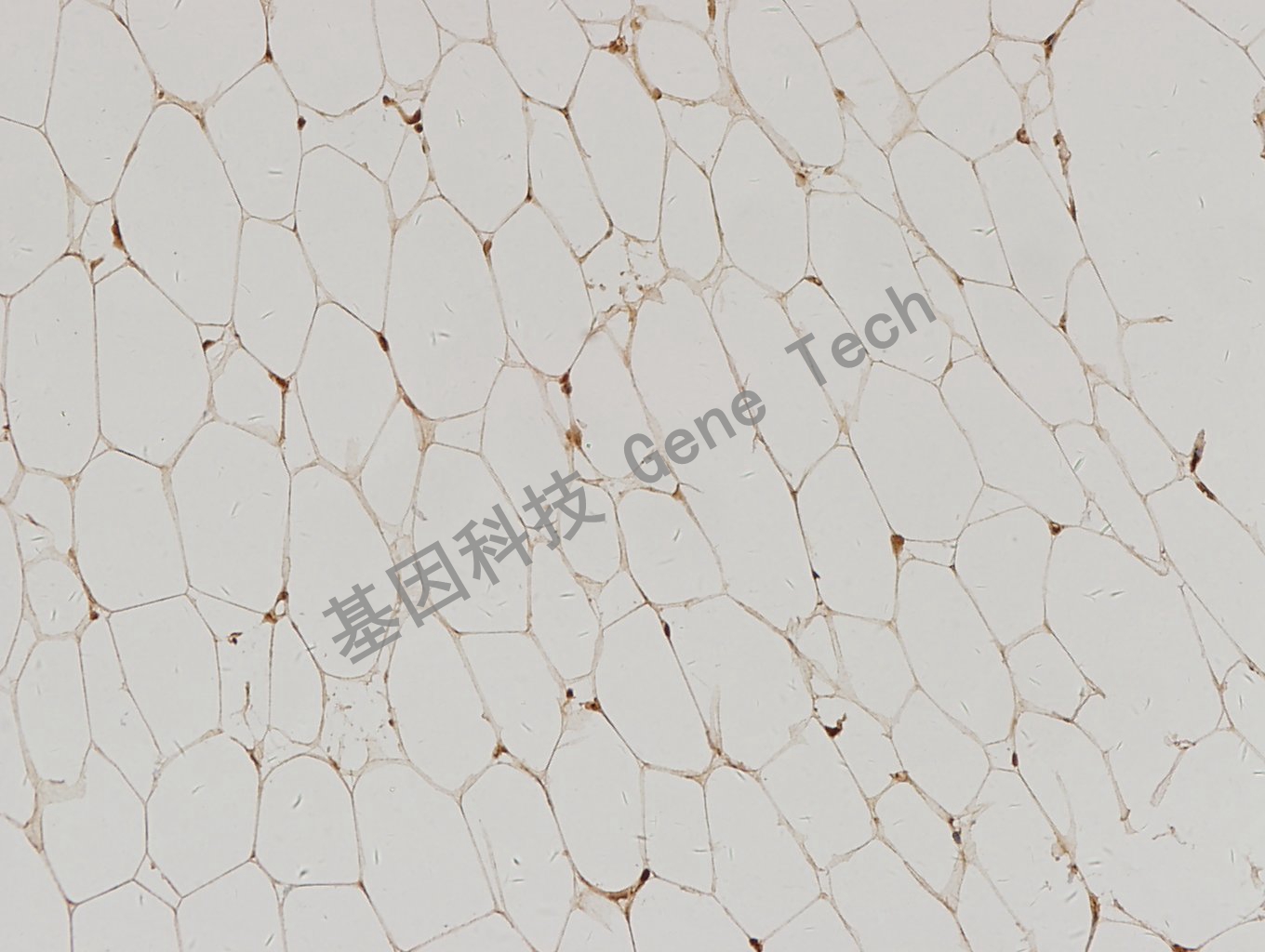 1595765592534110.jpg 20171225-8 脂肪肉瘤_副本.jpg