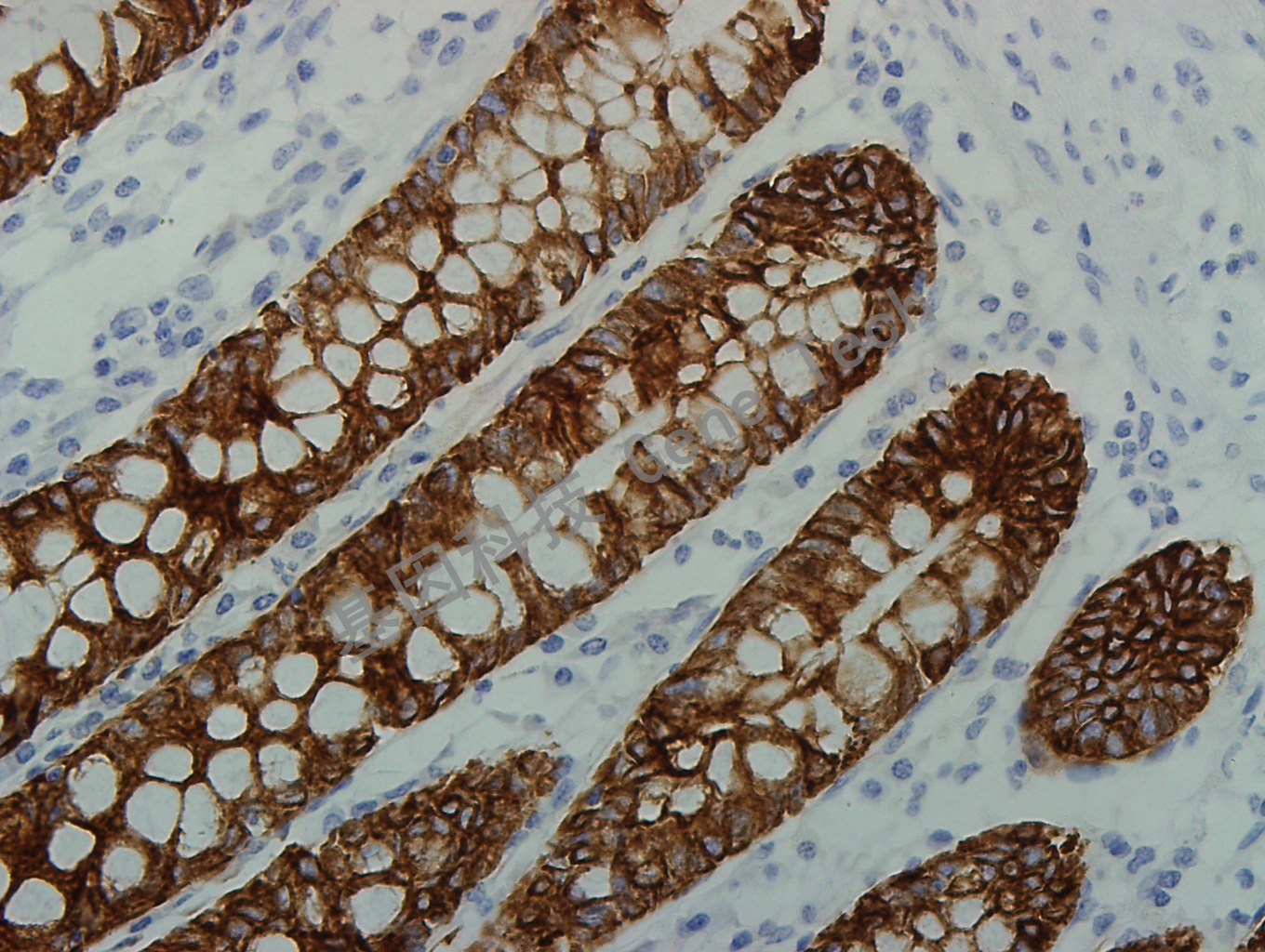 EMA(HMFG1) GT2243 结肠癌400_副本.jpg