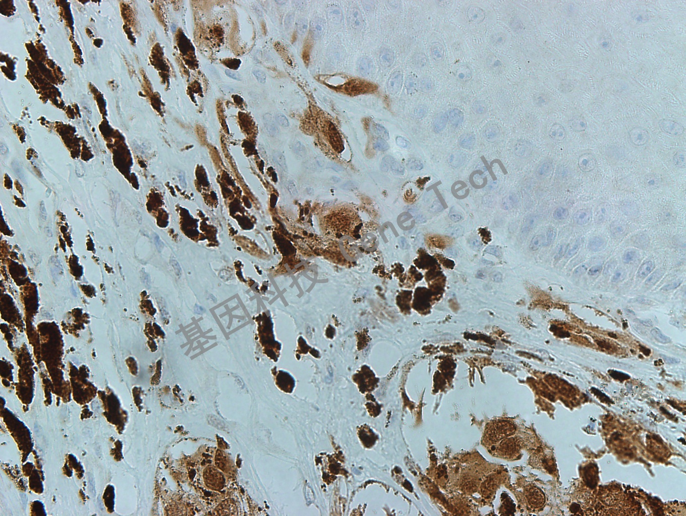 MITF GT2263 黑色素瘤40X_副本.jpg