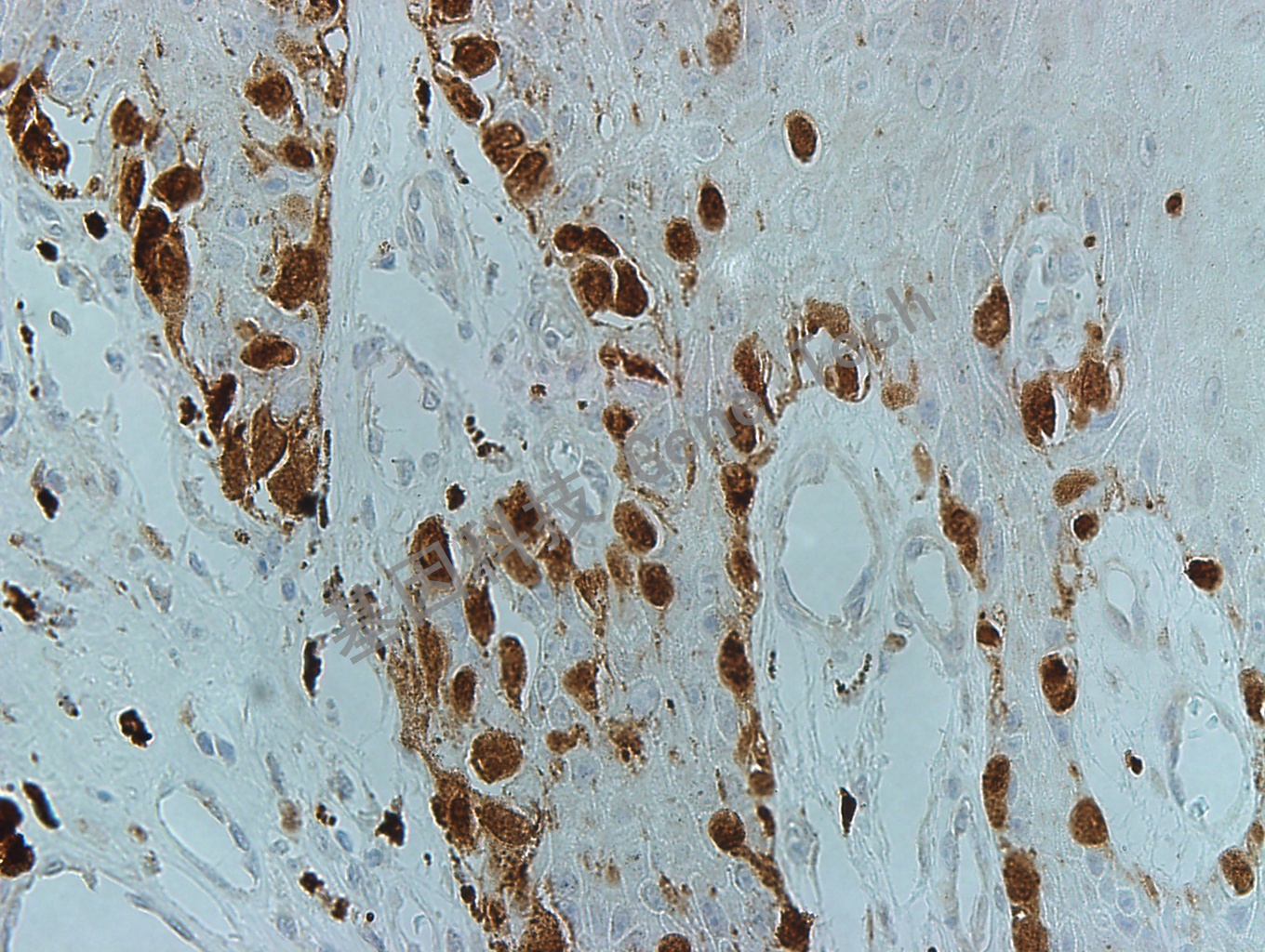 MITF GT2263 黑色素瘤40X-2_副本.jpg