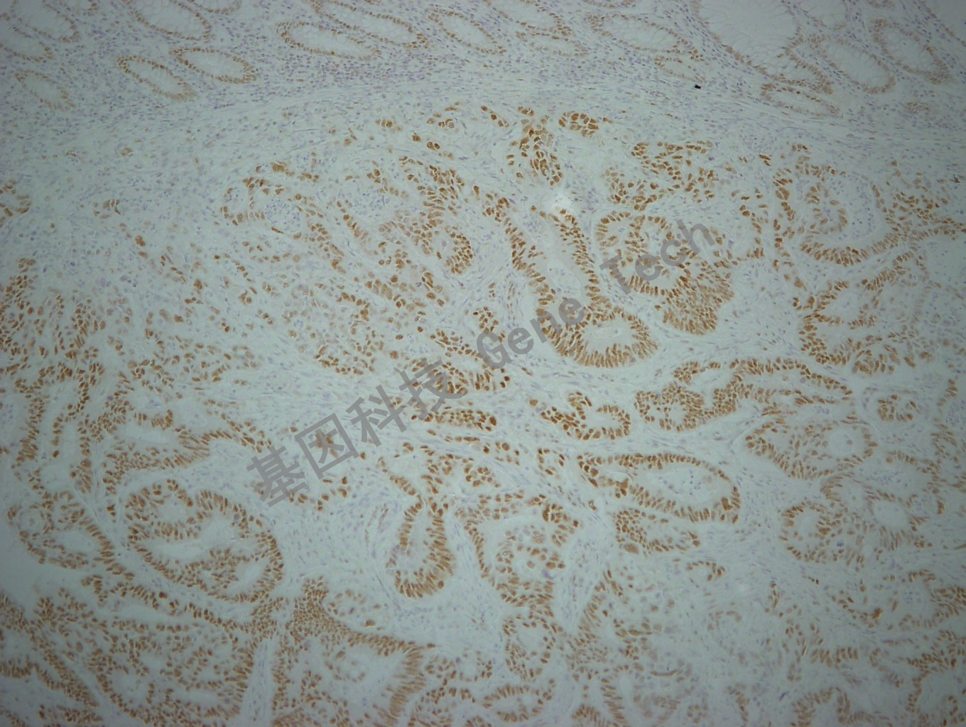 1595769702130627.jpg MLH1-结肠癌100_副本.jpg