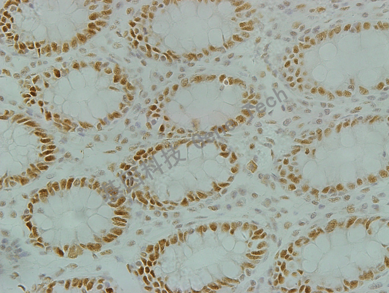 1595770457138024.jpg MLH1-结肠癌400_副本.jpg