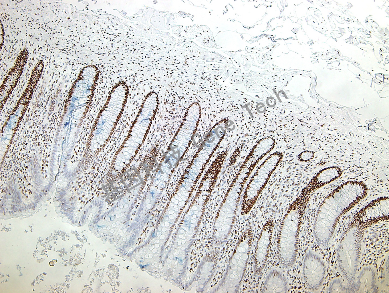 MSH6 GT2195 阑尾 胞核阳性_副本.jpg