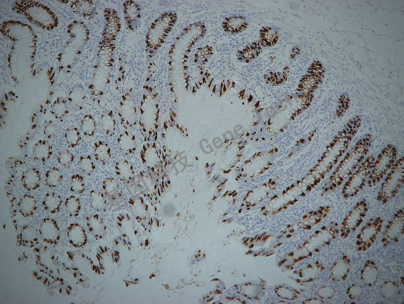 MUC2 GT2084 10X 结肠癌_副本.jpg