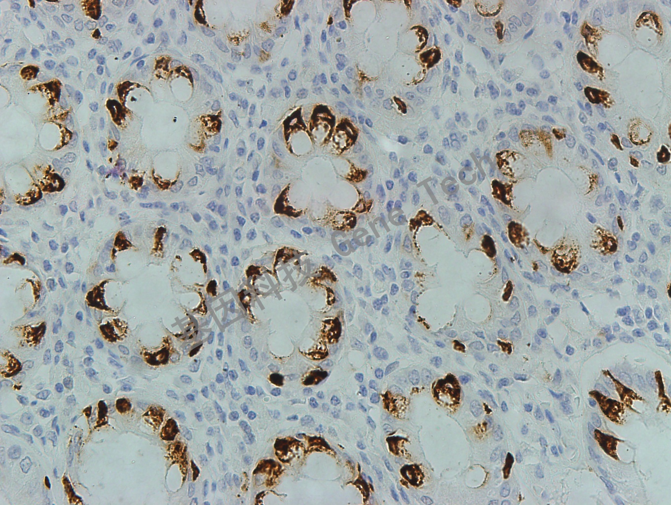 MUC2 GT2084 40X 结肠癌_副本.jpg