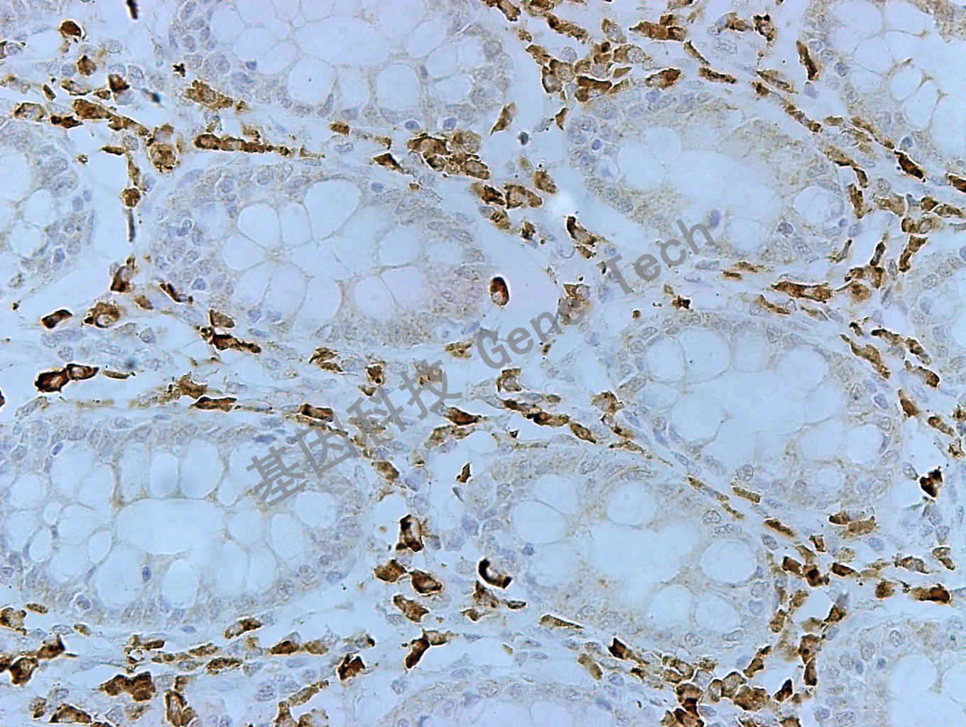 MUC-6 GT2220 结肠癌 40X_副本.jpg