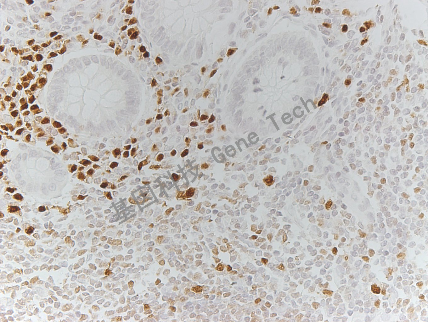 MUM1 GT2289 阑尾_副本.jpg