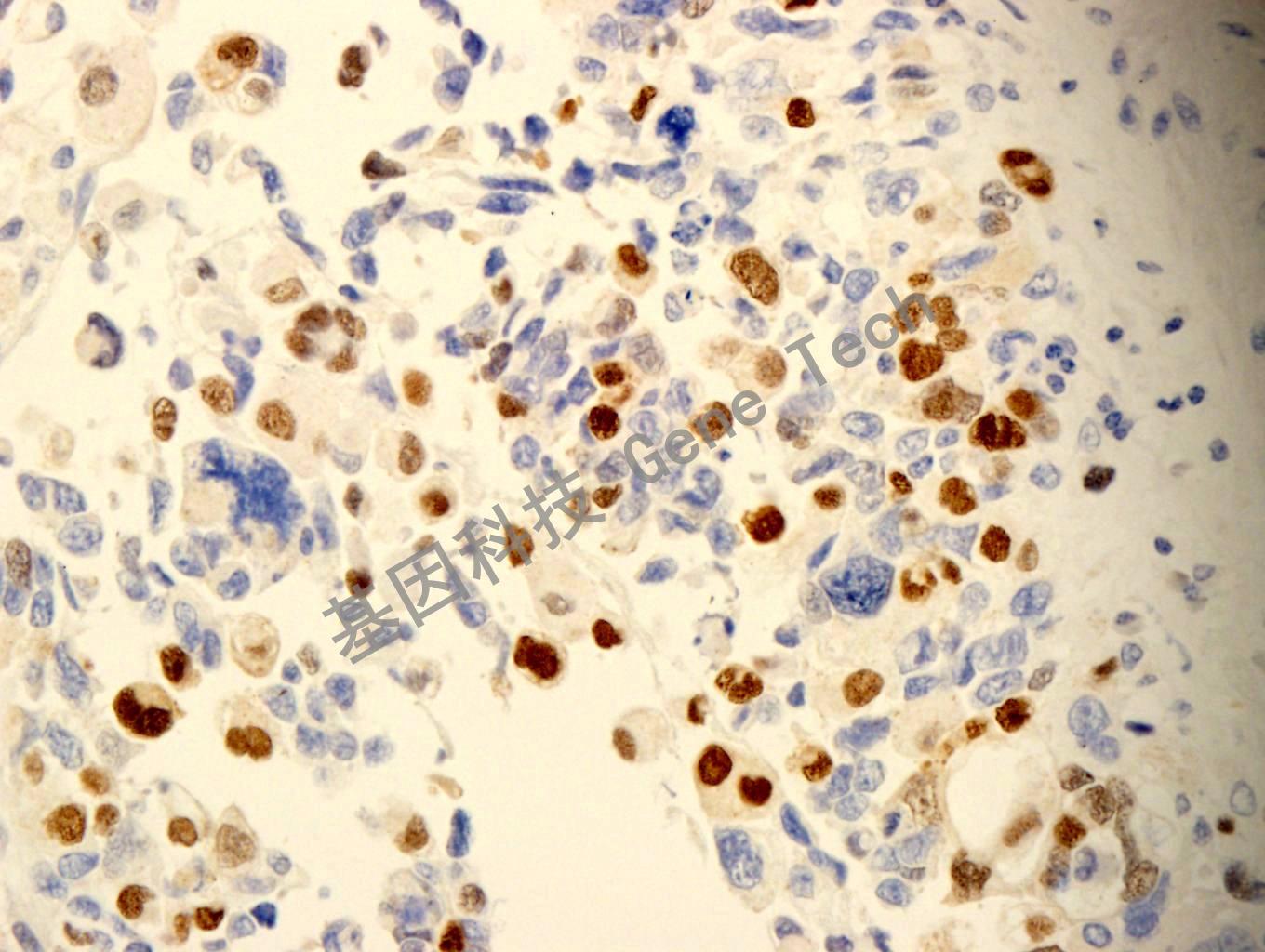 Myf-4 GT2269 横纹肌肉瘤 40X_副本.jpg