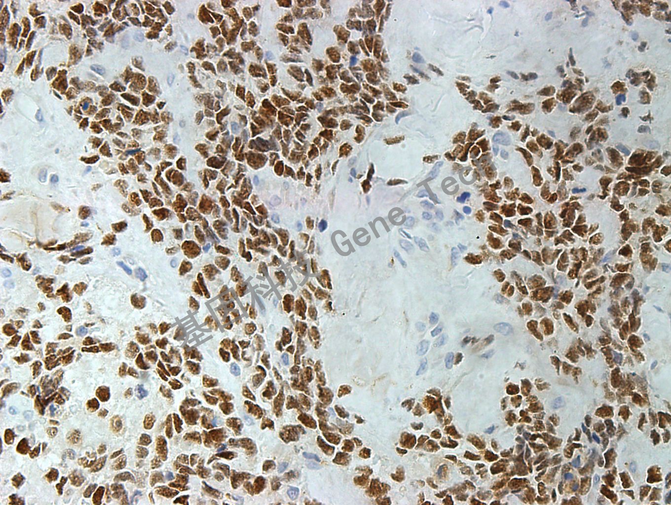 MyoD1 GT2188 横纹肌肉瘤_副本.jpg