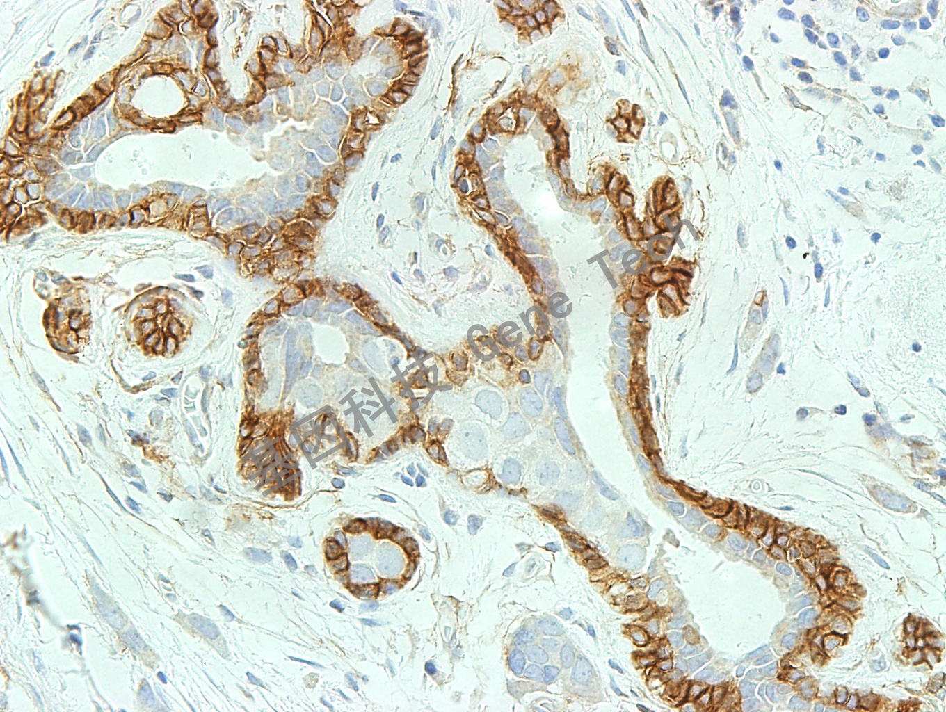 NGFR GT2258 40X 乳腺癌_副本.jpg