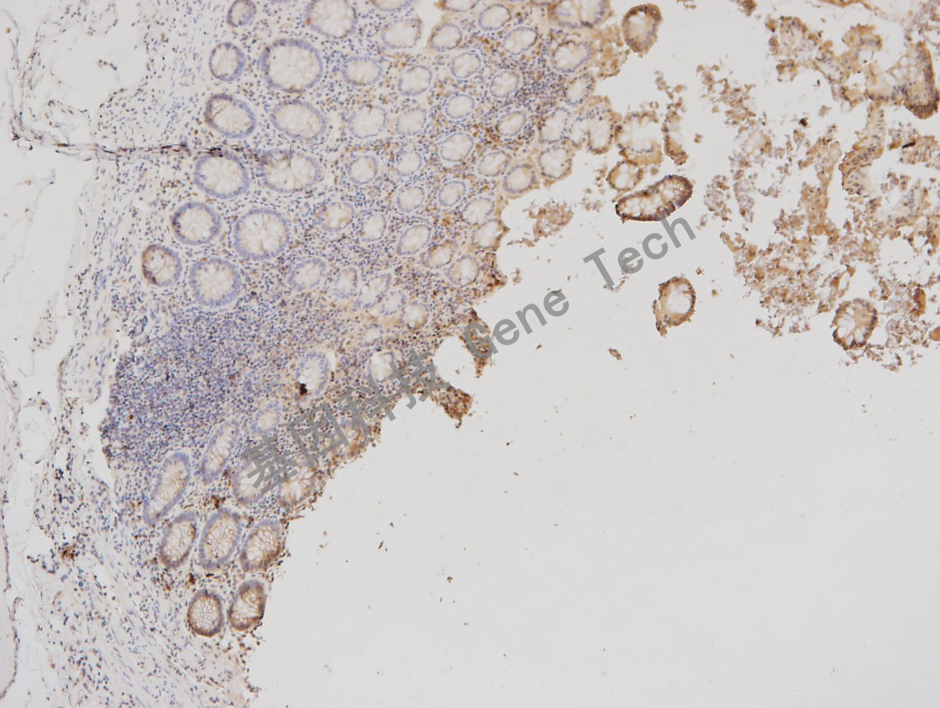 1595786735620131.jpg 20180125-8 07-T21 阑尾_副本.jpg