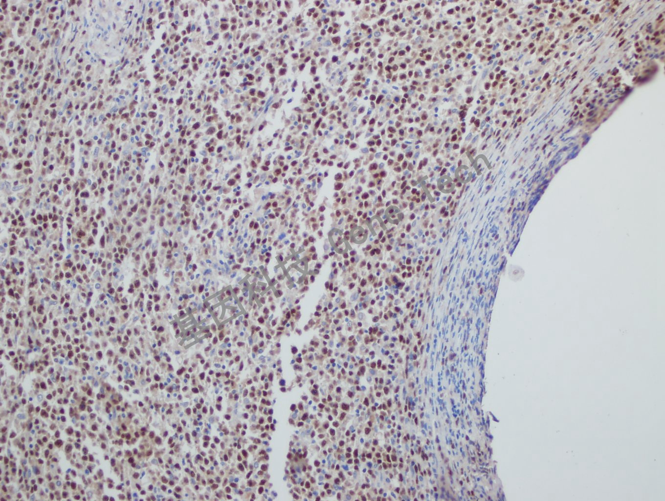 20181113-2 U7-2 弥漫性大B细胞淋巴瘤_副本.jpg