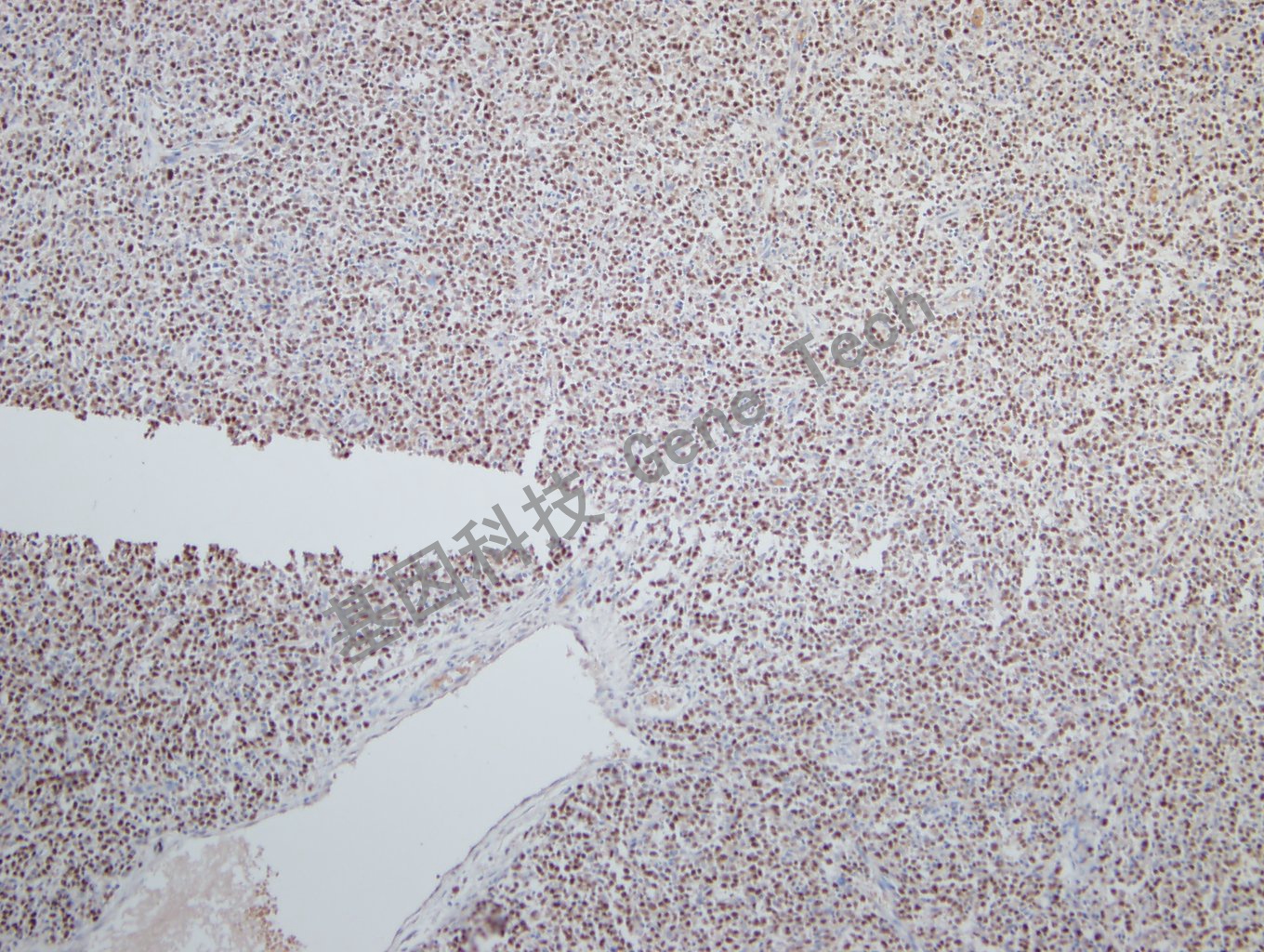 20181113-2 U7-3 弥漫性大B细胞淋巴瘤_副本.jpg