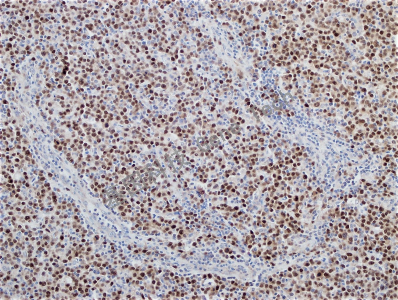 OCT-2 B细胞淋巴瘤_副本.jpg