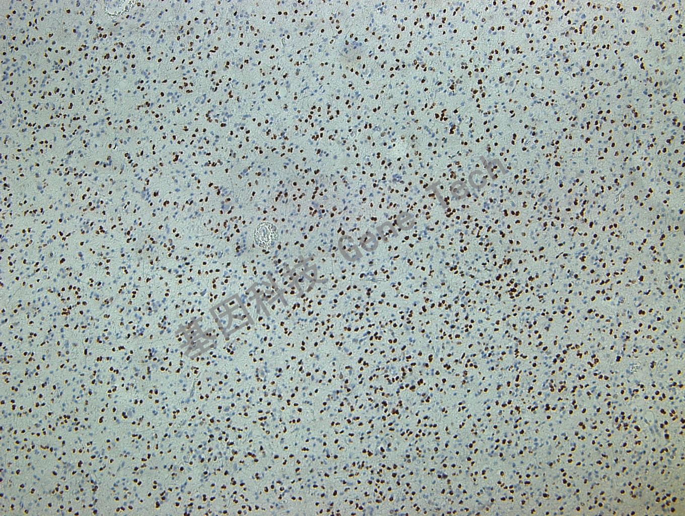 Olig2 GT2213 脑胶质瘤_副本.jpg